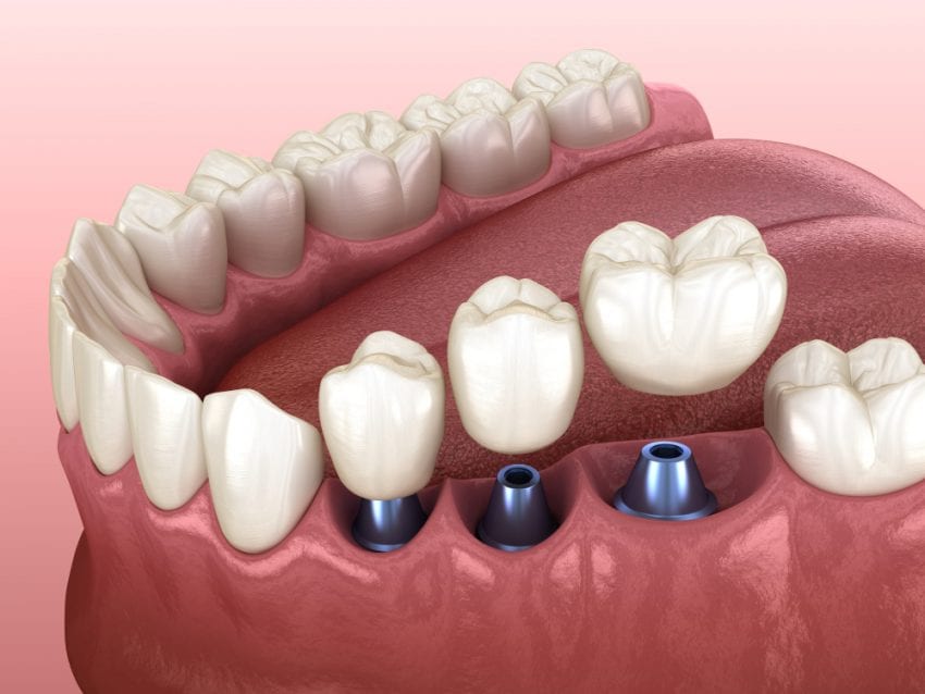 Dental Crowns & Veneers
